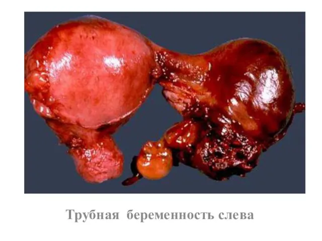 Трубная беременность слева