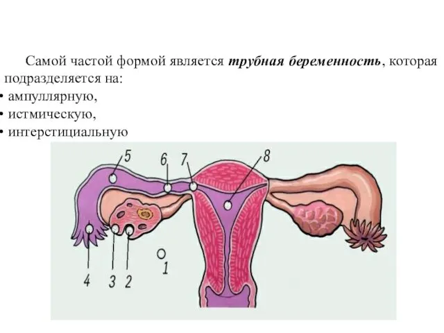 Самой частой формой является трубная беременность, которая подразделяется на: ампуллярную, истмическую, интерстициальную