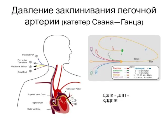 Давление заклинивания легочной артерии (катетер Свана—Ганца) ДЗЛК = ДЛП = КДДЛЖ