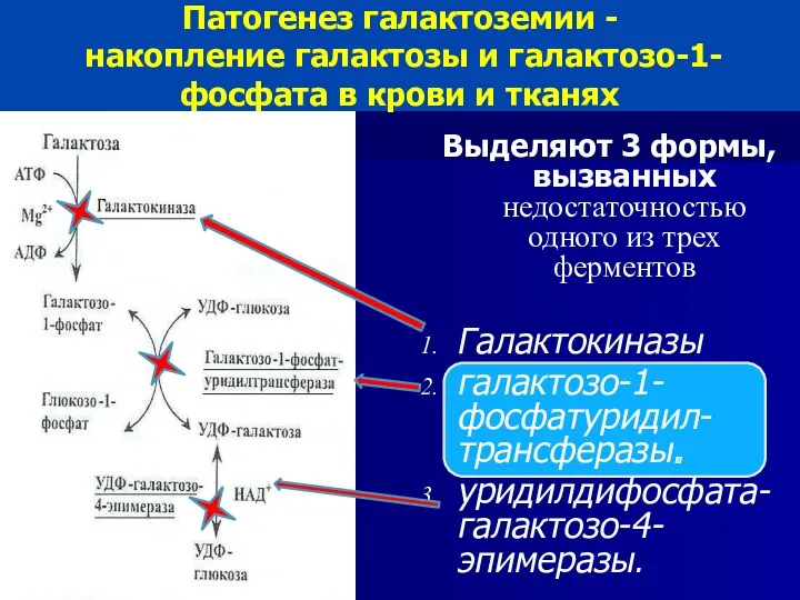 Патогенез галактоземии - накопление галактозы и галактозо-1-фосфата в крови и тканях Выделяют 3