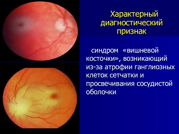 Характерный диагностический признак синдром «вишневой косточки», возникающий из-за атрофии ганглиозных клеток сетчатки и просвечивания сосудистой оболочки