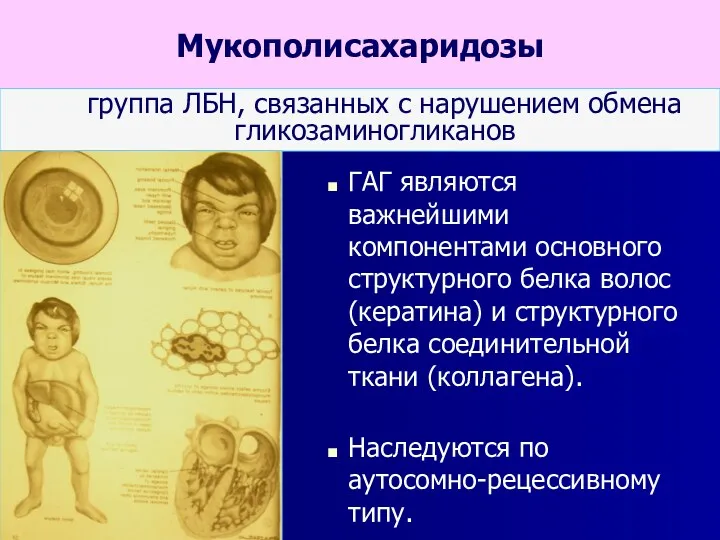 Мукополисахаридозы группа ЛБН, связанных с нарушением обмена гликозаминогликанов ГАГ являются важнейшими компонентами основного