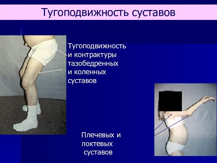 Тугоподвижность и контрактуры тазобедренных и коленных суставов Плечевых и локтевых суставов Тугоподвижность суставов