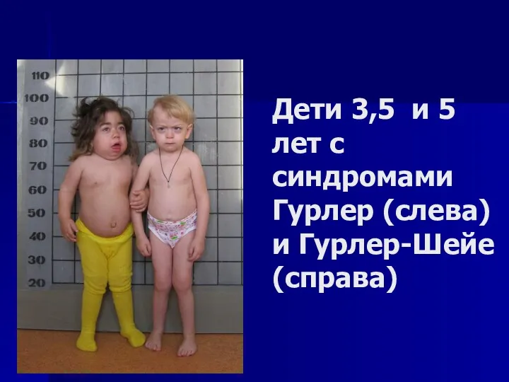 Дети 3,5 и 5 лет с синдромами Гурлер (слева) и Гурлер-Шейе (справа)