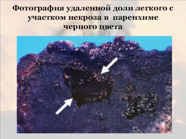Фотография удаленной доли легкого с участком некроза в паренхиме черного цвета