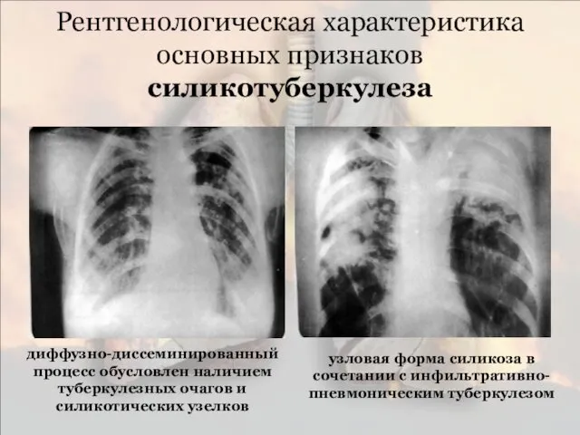 Рентгенологическая характеристика основных признаков силикотуберкулеза диффузно-диссеминированный процесс обусловлен наличием туберкулезных