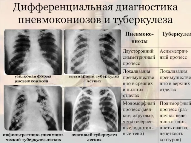 Дифференциальная диагностика пневмокониозов и туберкулеза узелковая форма пневмокониоза милиарный туберкулез