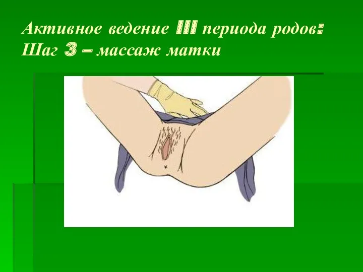 Активное ведение III периода родов: Шаг 3 – массаж матки