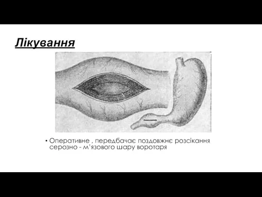 Лікування Оперативне , передбачає поздовжнє розсікання серозно - м’язового шару воротаря