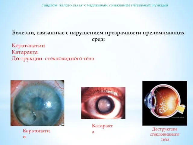 Болезни, связанные с нарушением прозрачности пре­ломляющих сред: Кератопатии Катаракта Деструкции стекловидного тела Кератопатии