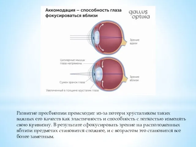 Развитие пресбиопии происходит из-за потери хрусталиком таких важных его качеств как эластичность и