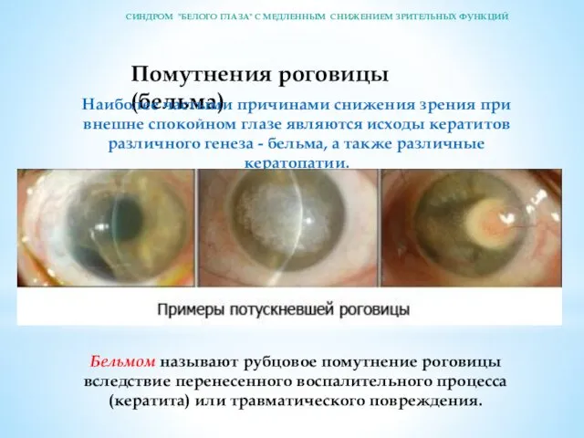 Помутнения роговицы (бельма) Наиболее частыми причинами снижения зрения при внешне