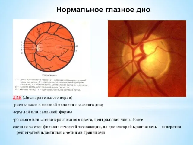 Нормальное глазное дно ДЗН (Диск зрительного нерва) -расположен в носовой половине глазного дна;