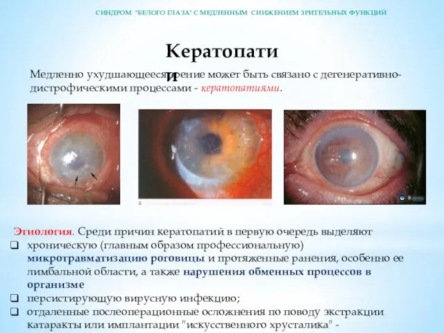 Кератопатии Медленно ухудшающееся зрение может быть связано с дегенеративно-дистрофическими процессами - кератопатиями. Этиология.
