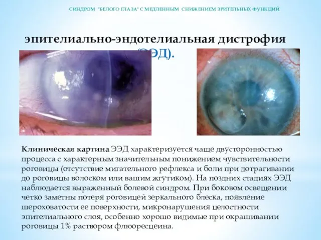 эпителиально-эндотелиальная дистрофия (ЭЭД). Клиническая картина ЭЭД характеризуется чаще двусторонностью процесса с характерным значительным