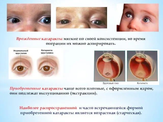 Приобретенные катаракты чаще всего плотные, с оформленным ядром, они подлежат вылущи­ванию (экстракции). Наиболее