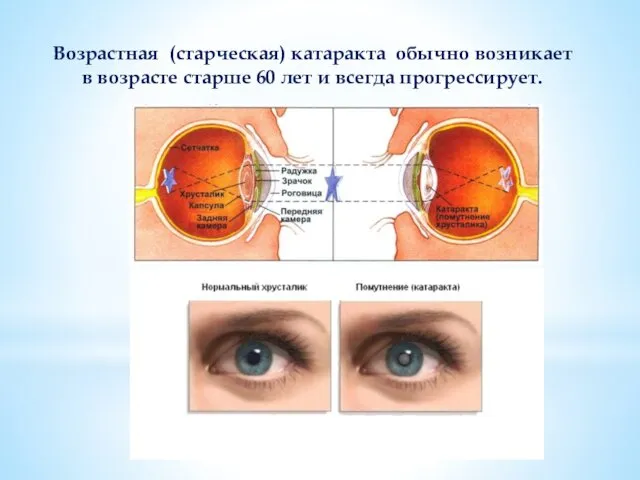 Возрастная (старческая) катаракта обычно возникает в возрасте старше 60 лет и всегда прогрессирует.
