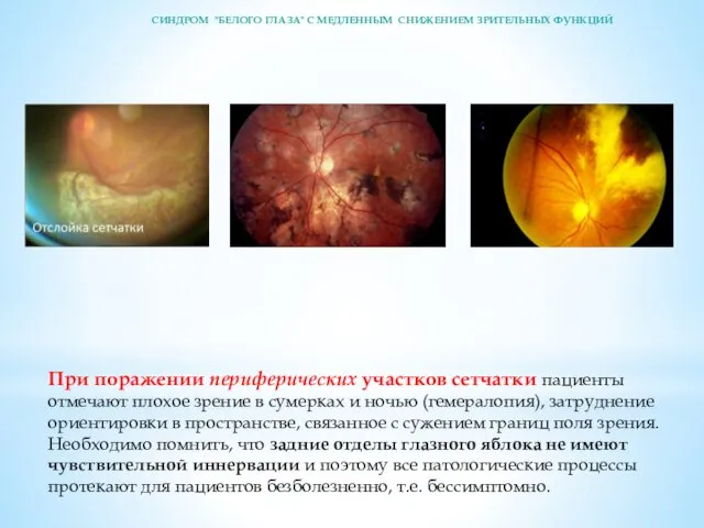 При поражении периферических участков сетчатки пациенты отмечают плохое зрение в