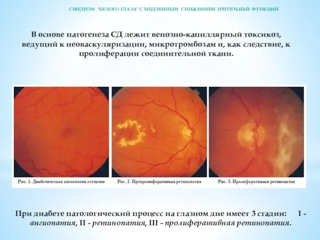 В основе патогенеза СД лежит венозно-капиллярный токсикоз, ведущий к неоваскуляризации,