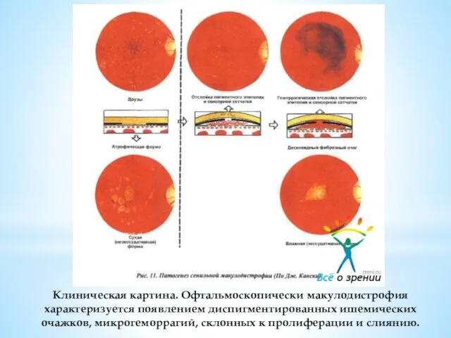 Клиническая картина. Офтальмоскопически макулодистрофия характеризуется появлением диспигментированных ишемических очажков, микрогеморрагий, склонных к пролиферации и слиянию.