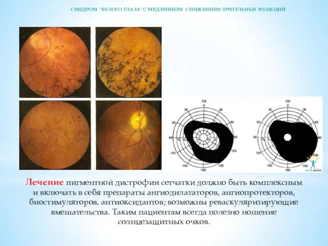 Лечение пигментной дистрофии сетчатки должно быть комплексным и включать в