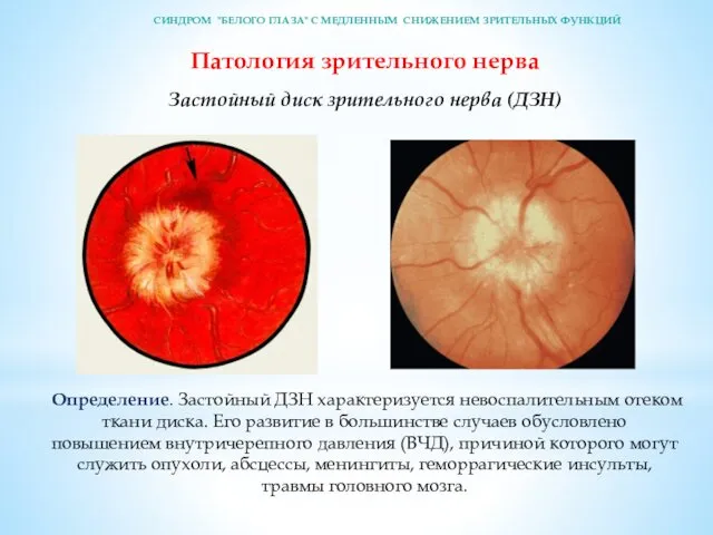 Патология зрительного нерва Застойный диск зрительного нерва (ДЗН) Определение. Застойный ДЗН характеризуется невос­палительным