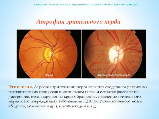 Атрофия зрительного нерва Этиология. Атрофия зрительного нерва является след­ствием различных патологических процессов в