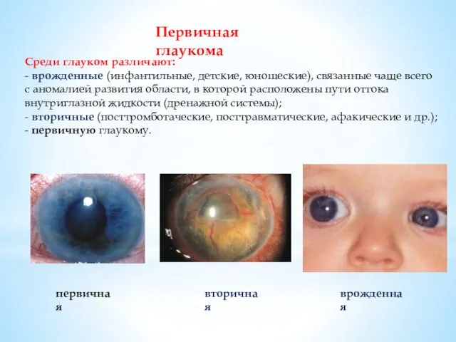 Среди глауком различают: - врожденные (инфантильные, детские, юношеские), связанные чаще всего с аномалией