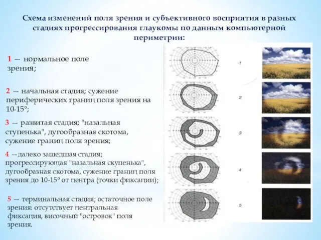 Схема изменений поля зрения и субъективного восприятия в разных стадиях