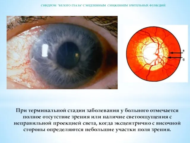 При терминальной стадии заболевания у больного отмечается полное отсутствие зрения или наличие светоощущения