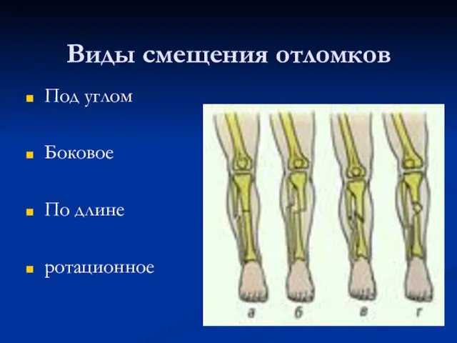 Виды смещения отломков Под углом Боковое По длине ротационное