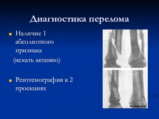 Диагностика перелома Наличие 1 абсолютного признака (искать активно) Рентгенография в 2 проекциях