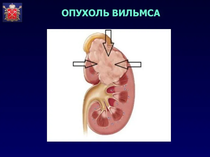 ОПУХОЛЬ ВИЛЬМСА