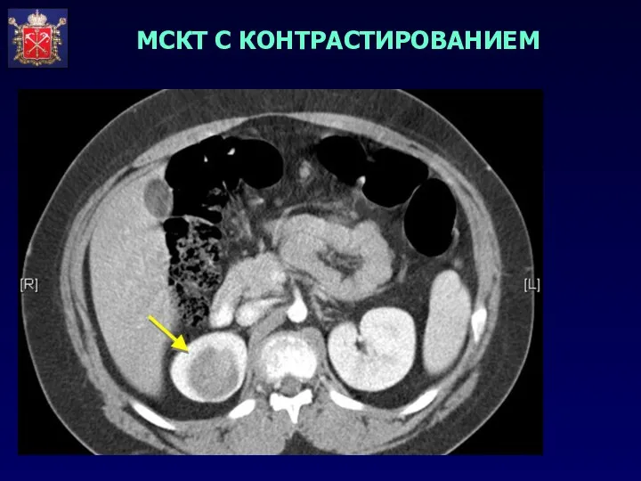 МСКТ С КОНТРАСТИРОВАНИЕМ