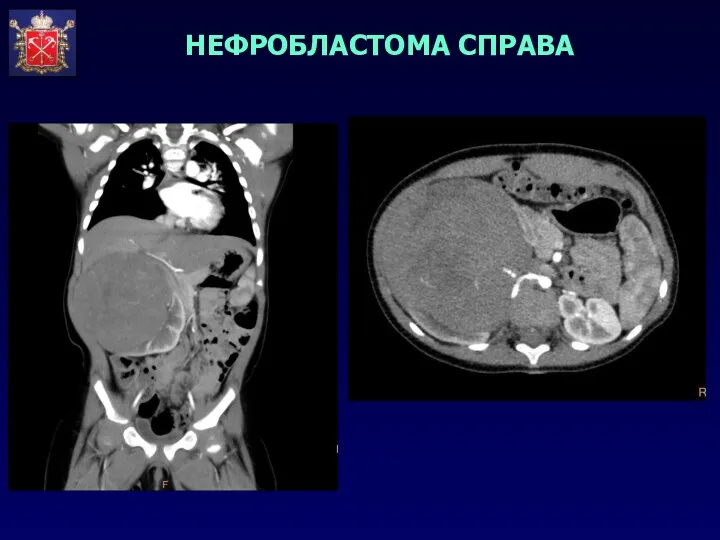 НЕФРОБЛАСТОМА СПРАВА