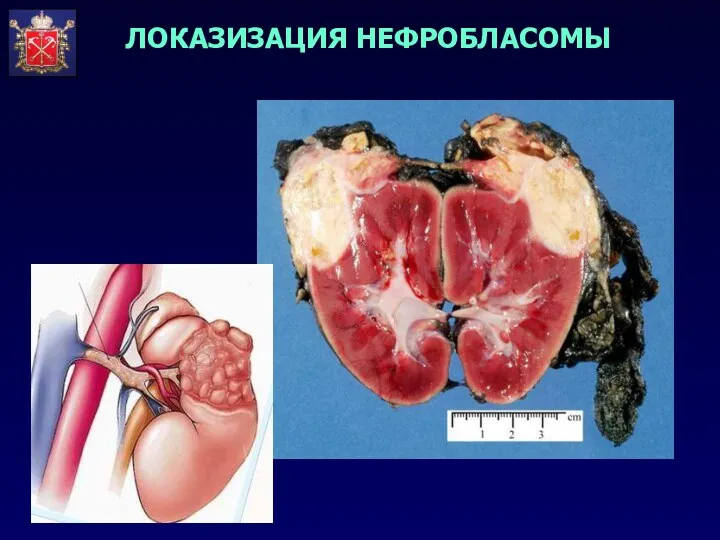 ЛОКАЗИЗАЦИЯ НЕФРОБЛАСОМЫ