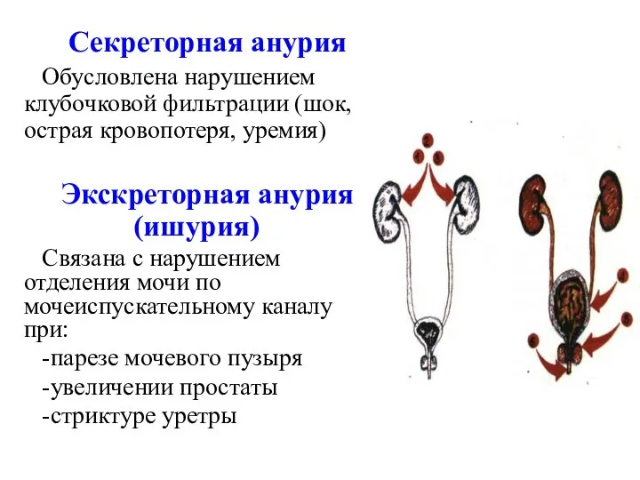 Секреторная анурия Обусловлена нарушением клубочковой фильтрации (шок, острая кровопотеря, уремия)