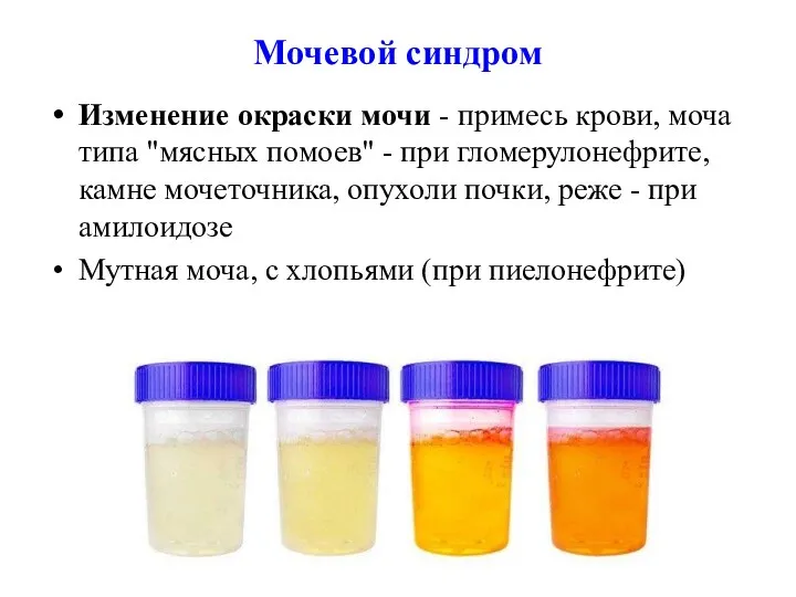 Мочевой синдром Изменение окраски мочи - примесь крови, моча типа