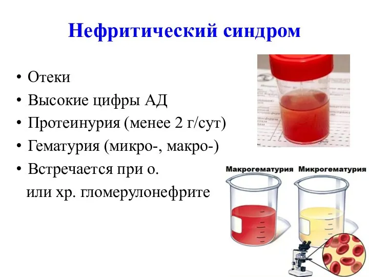 Нефритический синдром Отеки Высокие цифры АД Протеинурия (менее 2 г/сут)