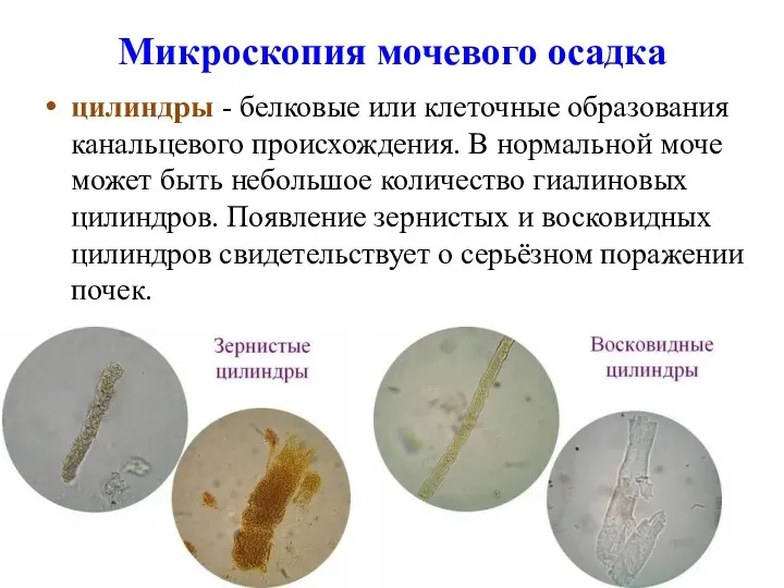 Микроскопия мочевого осадка цилиндры - белковые или клеточные образования канальцевого