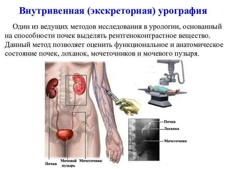 Внутривенная (экскреторная) урография Один из ведущих методов исследования в урологии,