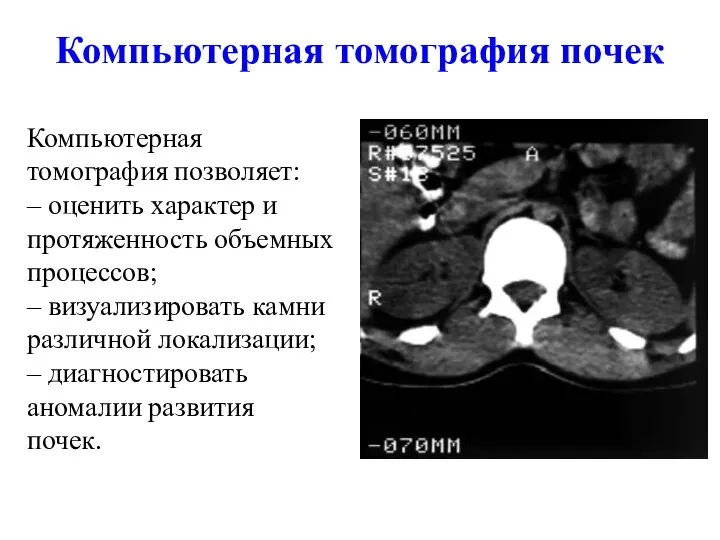 Компьютерная томография почек Компьютерная томография позволяет: – оценить характер и