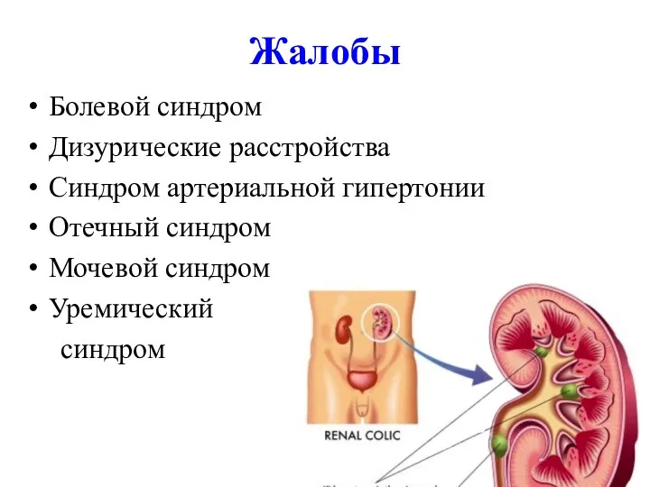Жалобы Болевой синдром Дизурические расстройства Синдром артериальной гипертонии Отечный синдром Мочевой синдром Уремический синдром