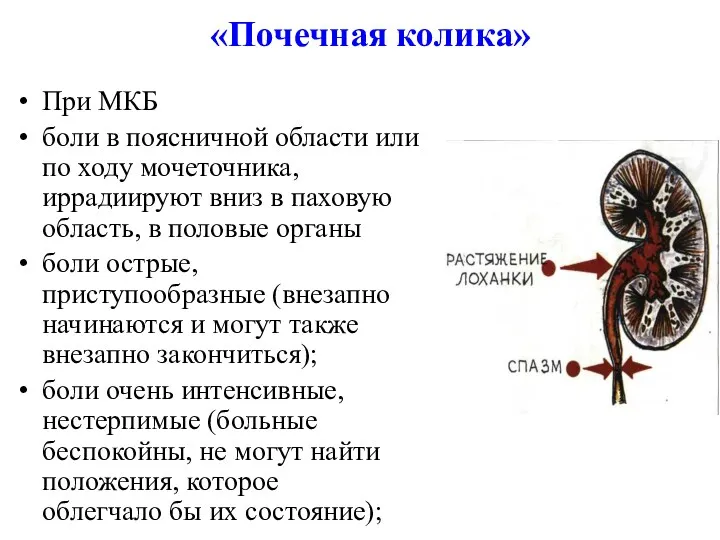 «Почечная колика» При МКБ боли в поясничной области или по