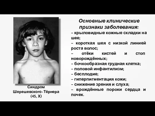 Синдром Шерешевского-Тёрнера (45, Х) Основные клинические признаки заболевания: – крыловидные