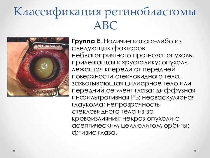 Классификация ретинобластомы АВС Группа E. Наличие какого-либо из следующих факторов