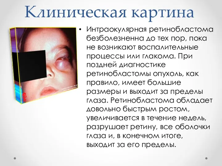 Клиническая картина Интраокулярная ретинобластома безболезненна до тех пор, пока не