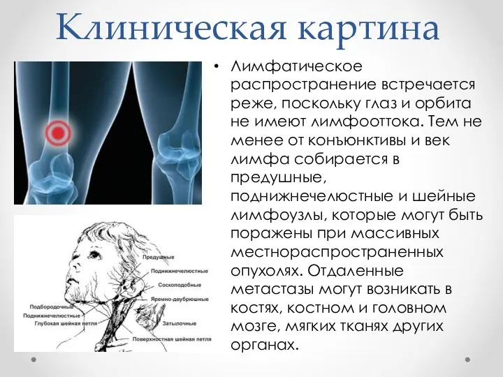 Клиническая картина Лимфатическое распространение встречается реже, поскольку глаз и орбита