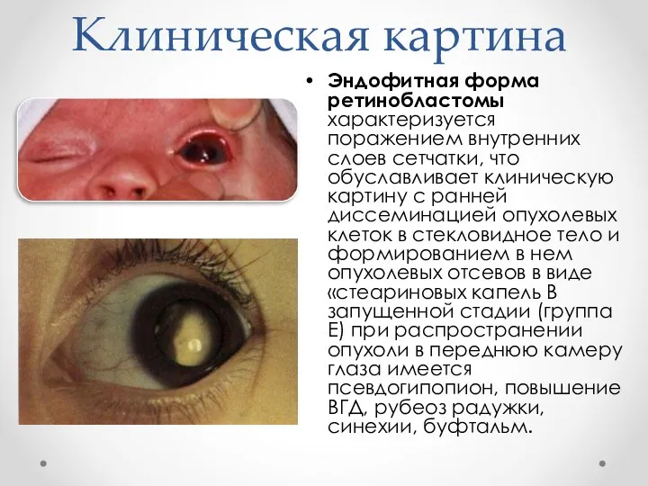 Клиническая картина Эндофитная форма ретинобластомы характеризуется поражением внутренних слоев сетчатки,