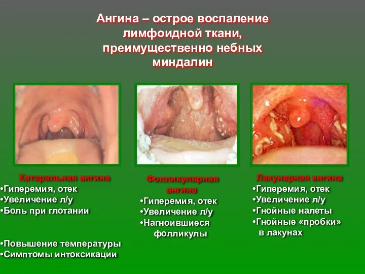 Ангина – острое воспаление лимфоидной ткани, преимущественно небных миндалин Катаральная